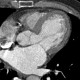 Hypodense subendocardial layer, myocardial infarction: CT - Computed tomography